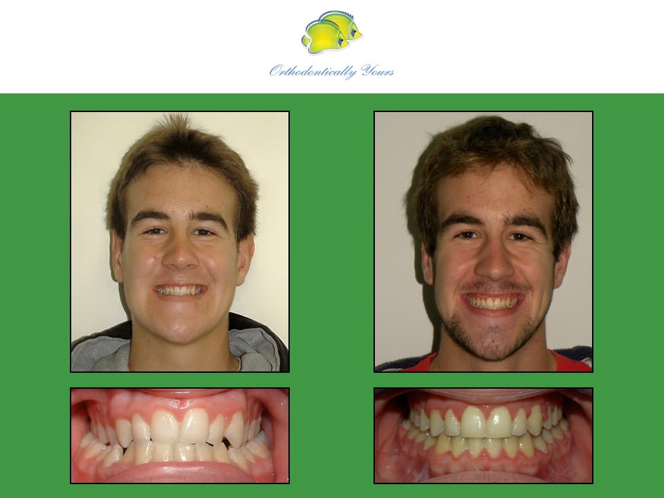 Before and after treatment at Orthodontically Yours in Mississauga Thornhill ON