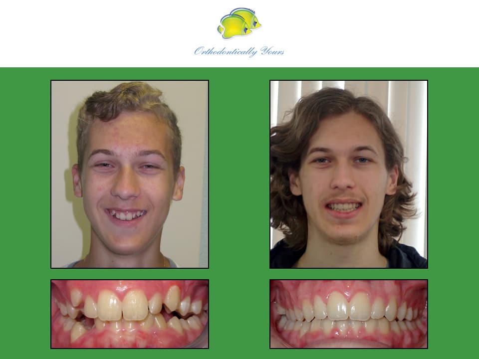 Before and after treatment at Orthodontically Yours in Mississauga Thornhill ON