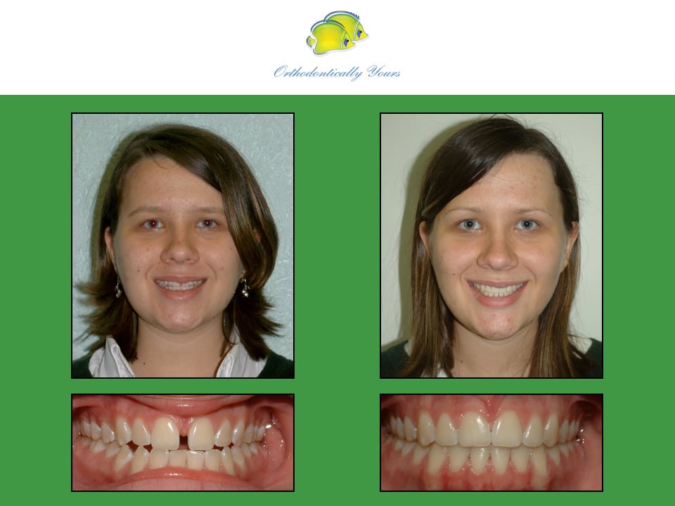 Before and after treatment at Orthodontically Yours in Mississauga Thornhill ON