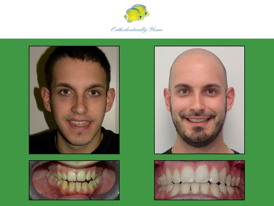 Before and after treatment at Orthodontically Yours in Mississauga Thornhill ON