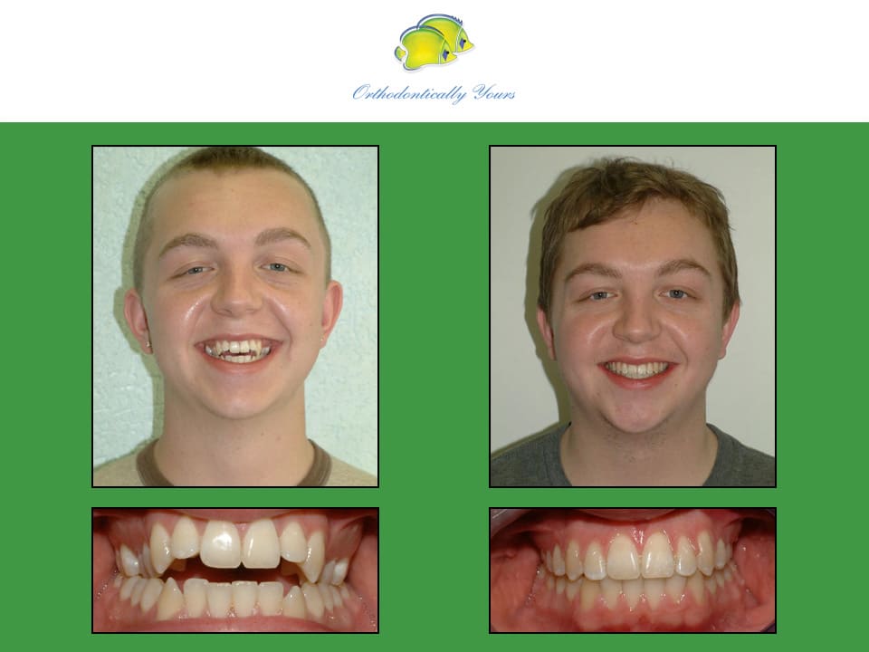 Before and after treatment at Orthodontically Yours in Mississauga Thornhill ON