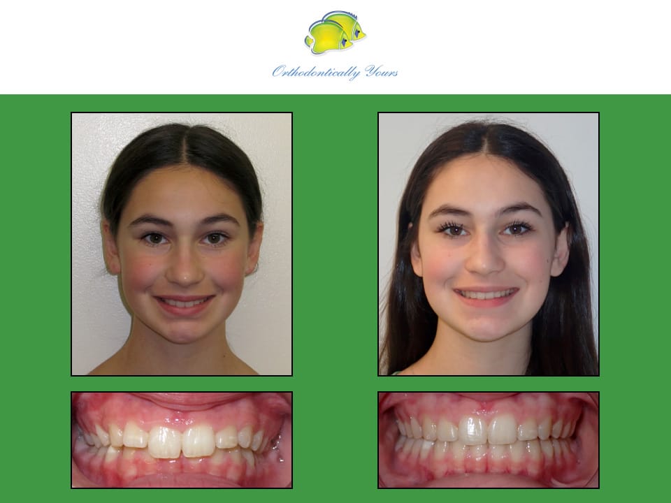 Before and after treatment at Orthodontically Yours in Mississauga Thornhill ON
