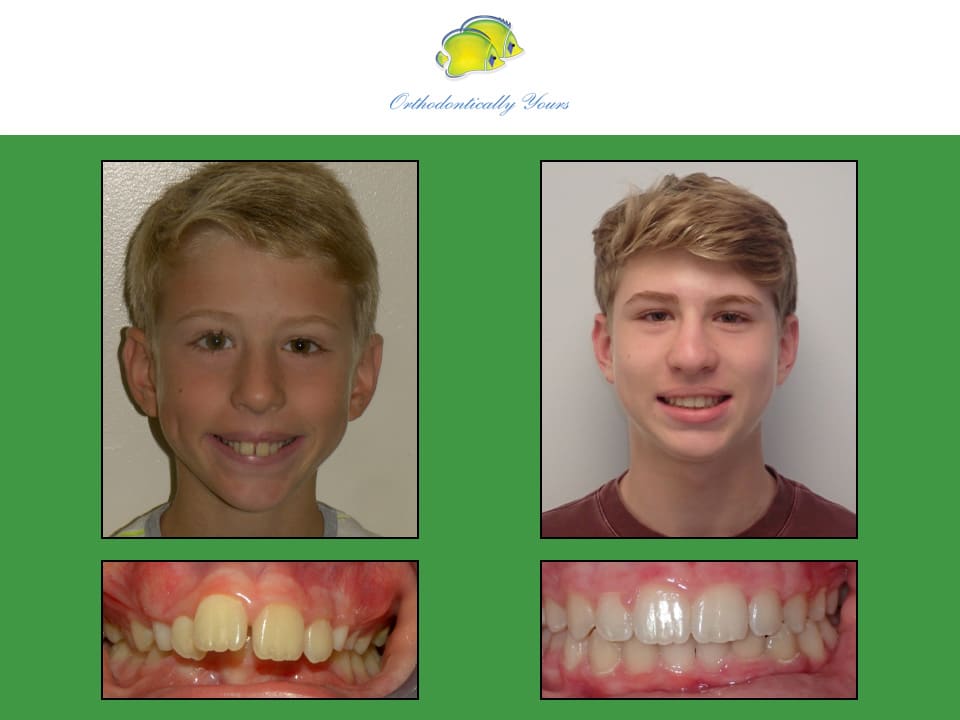 Before and after treatment at Orthodontically Yours in Mississauga Thornhill ON