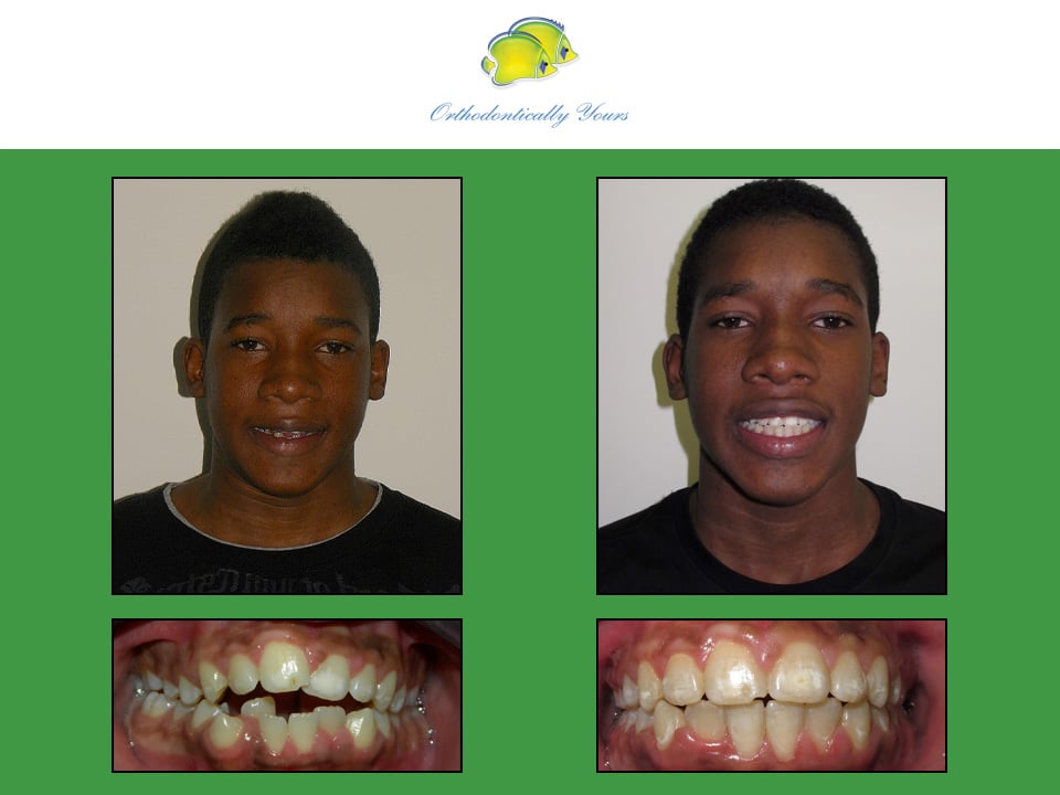 Before and after treatment at Orthodontically Yours in Mississauga Thornhill ON