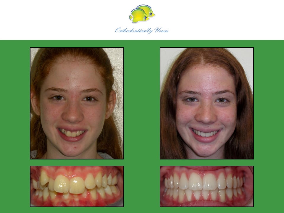 Before and after treatment at Orthodontically Yours in Mississauga Thornhill ON