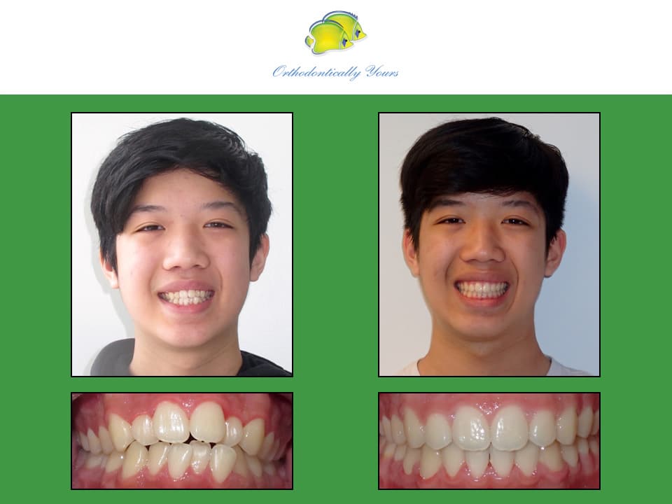 Before and after treatment at Orthodontically Yours in Mississauga Thornhill ON