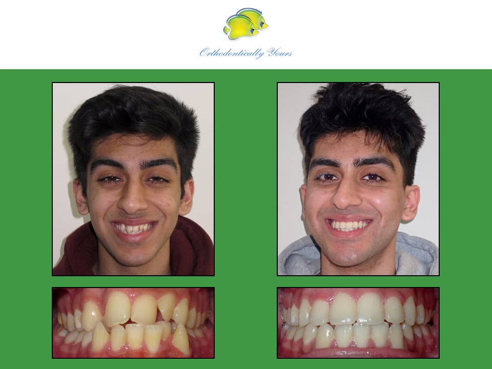 Before and after treatment at Orthodontically Yours in Mississauga Thornhill ON