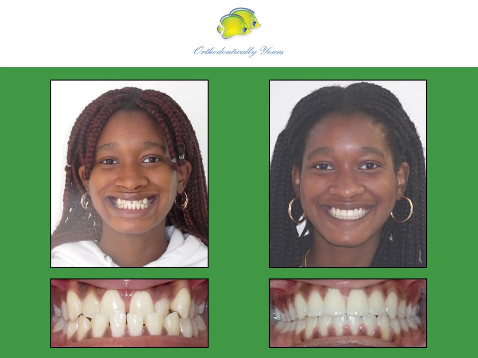 Before and after treatment at Orthodontically Yours in Mississauga Thornhill ON